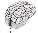 bleeding_brain